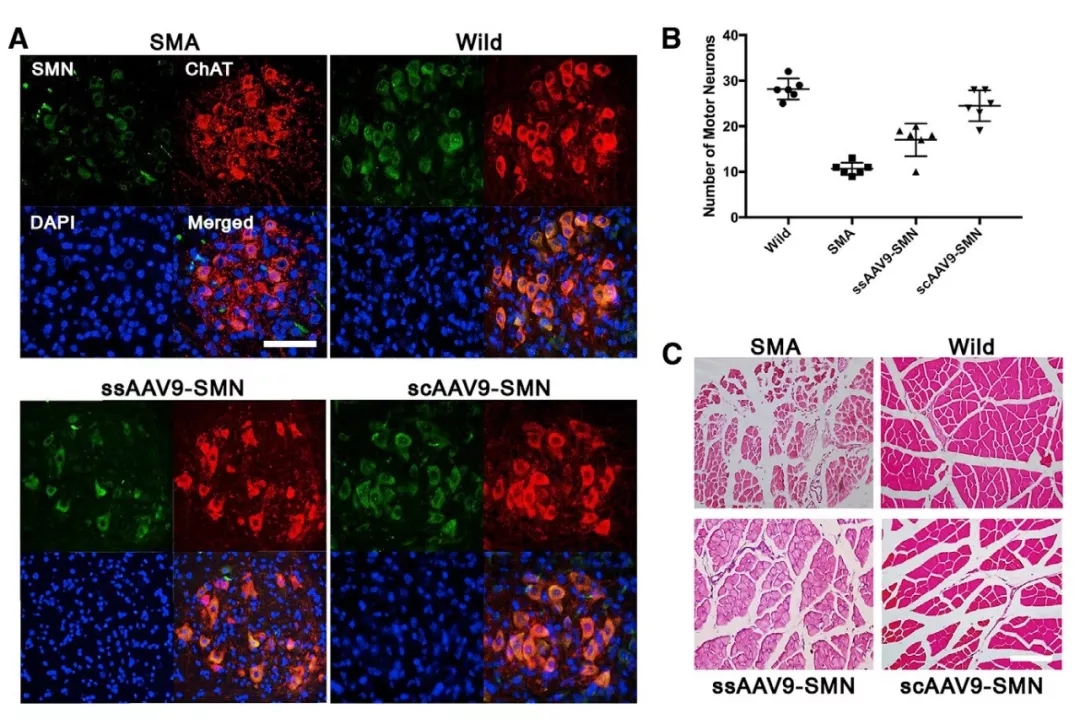 与时间赛跑，基于rAAV9载体胎儿基因治疗SMA新进展（一）